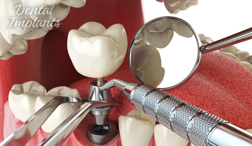 Dental Implants 852x495